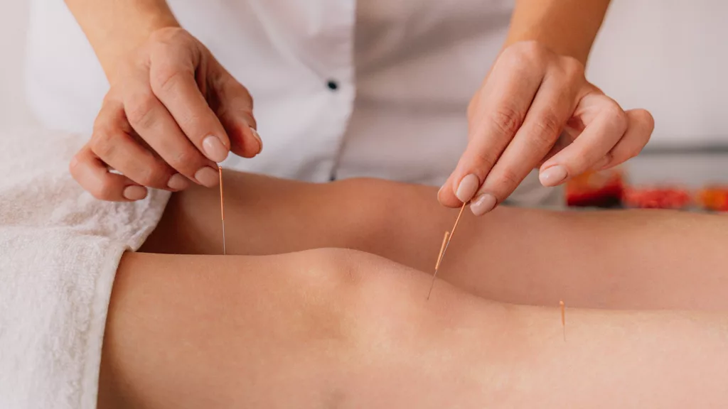 The Best Acupuncture Therapy For Pain Relief And Wellness