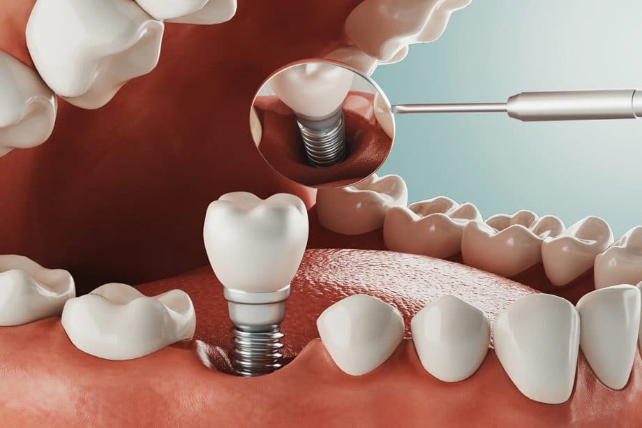 The Best Dental Implants: A Comprehensive Guide